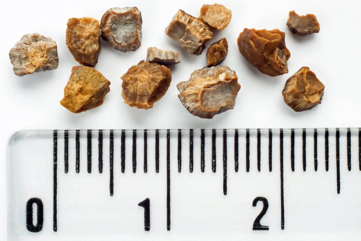 Debunking 3 Common Kidney Stone Myths
